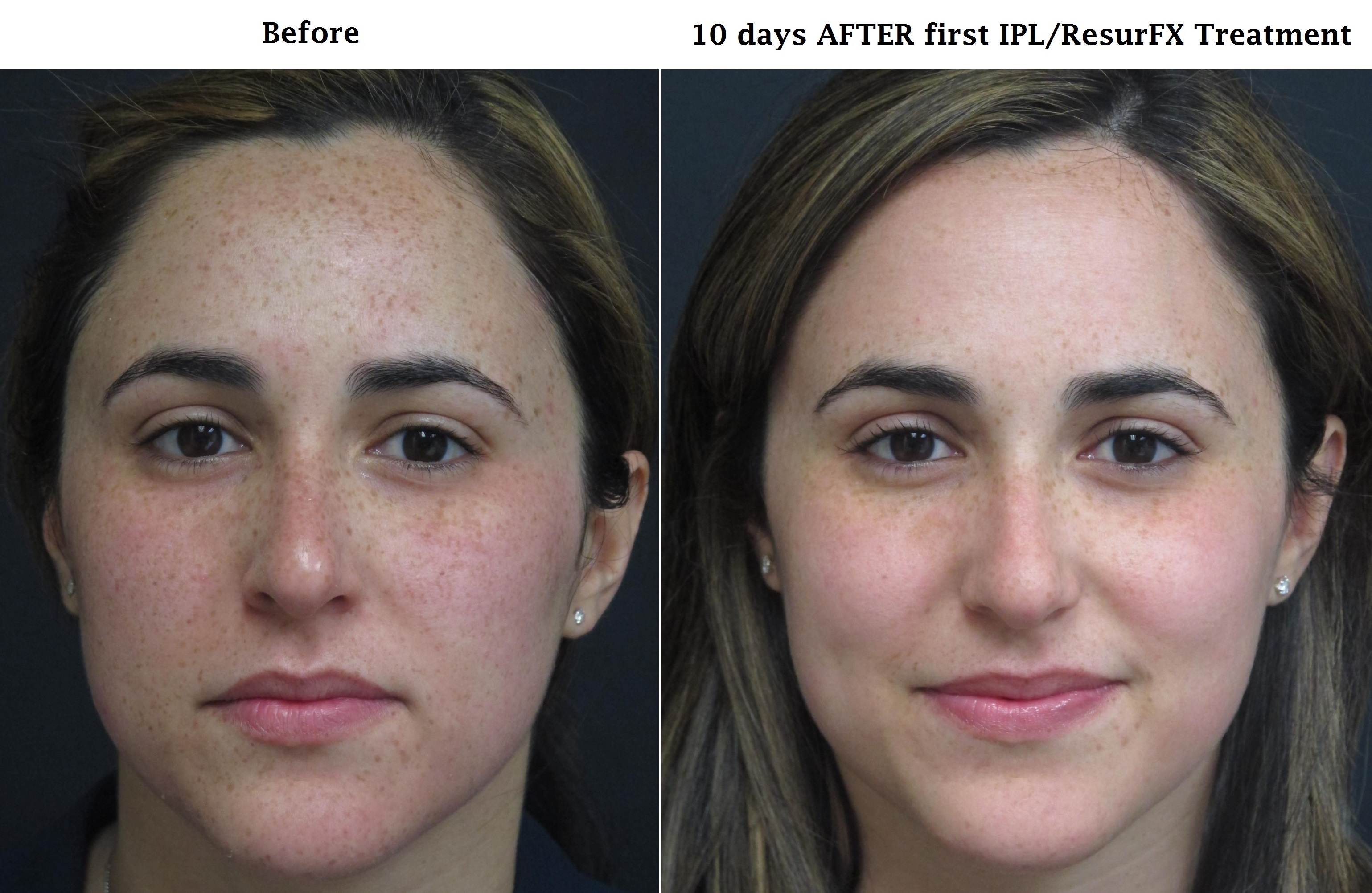 Diminish facial spots permanently